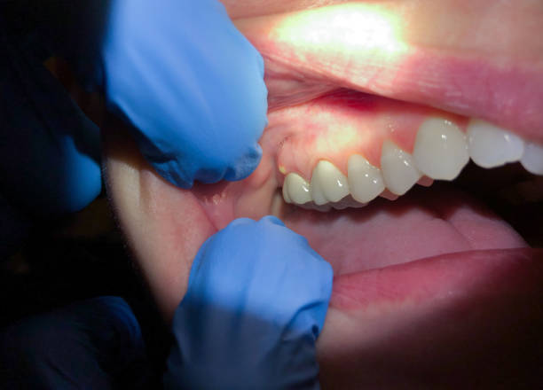 Best Emergency Dental Care for Broken or Chipped Teeth in Kittredge, CO