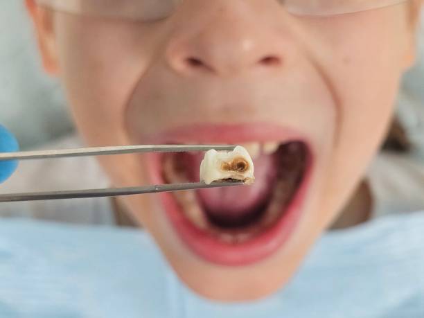 Best Emergency Tooth Extraction in Kittredge, CO
